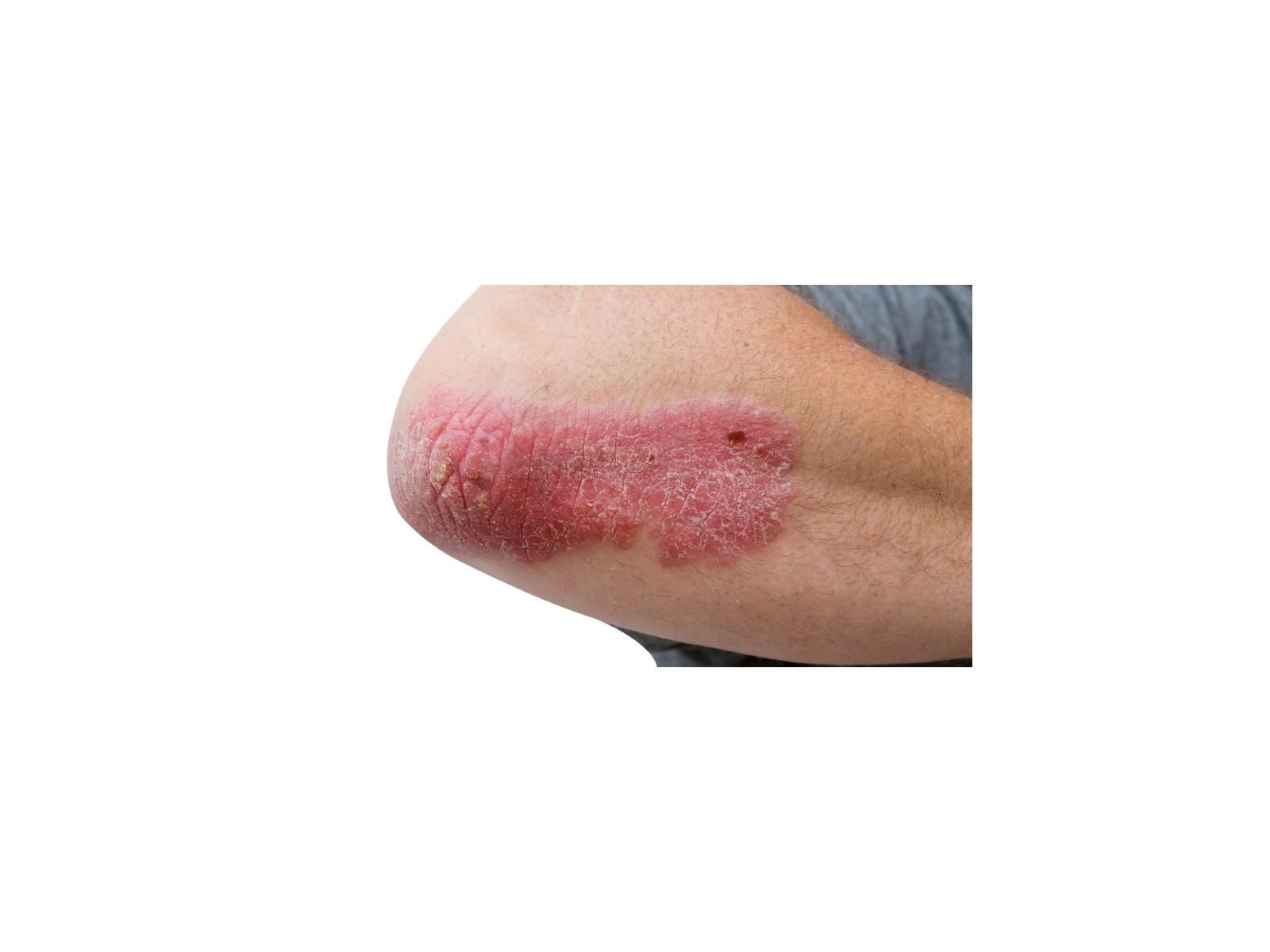 The truth about acne, eczema and psoriasis