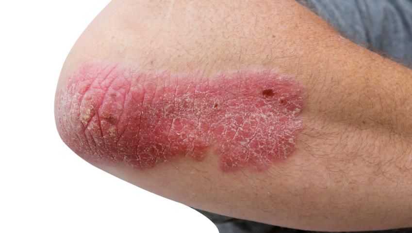 The truth about acne, eczema and psoriasis